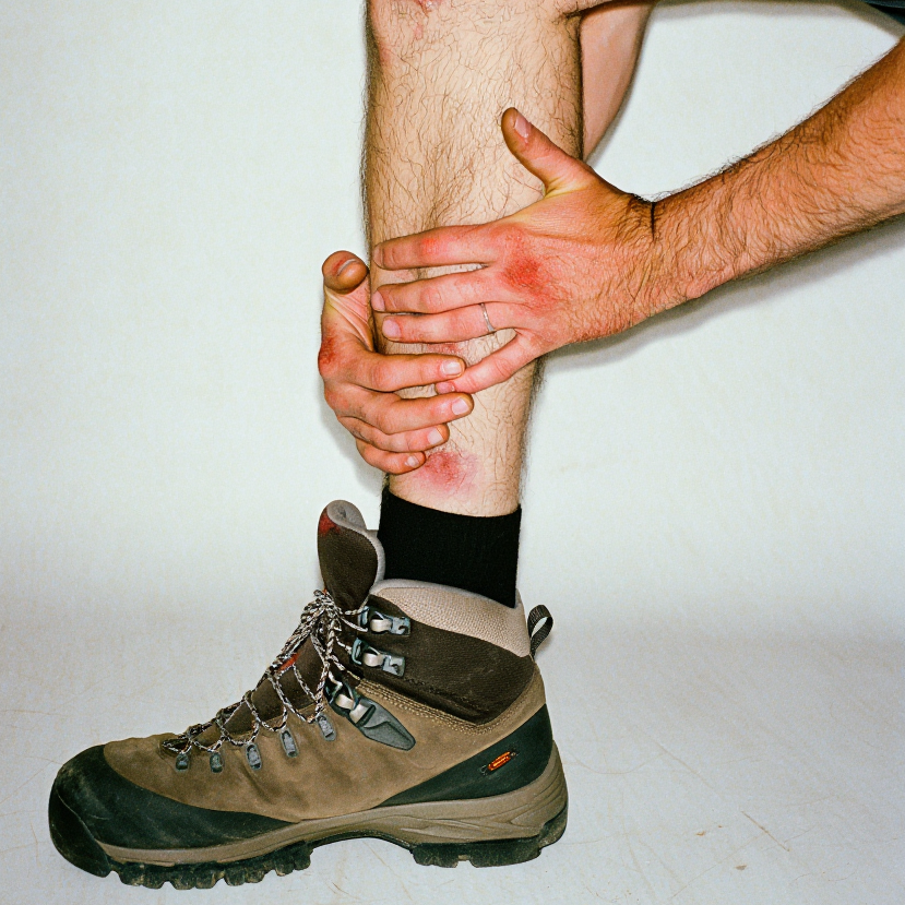 Hiking boot on a person's foot with visible redness and inflammation.
